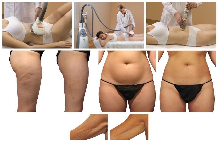 Velashape