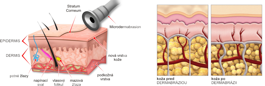 Diamantová dermabrázia