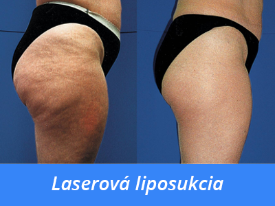 laserová liposukcia