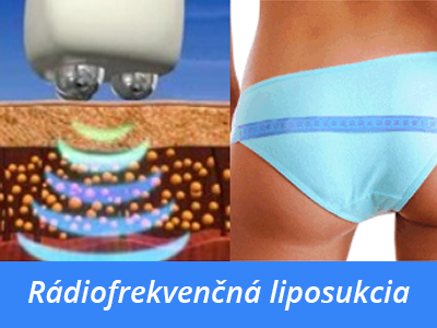 radiofrekvenčná liposukcia