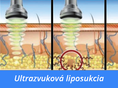 ultrazvuková liposukcia